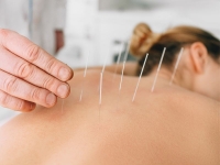 acupunctuur