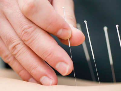 dry-needling1